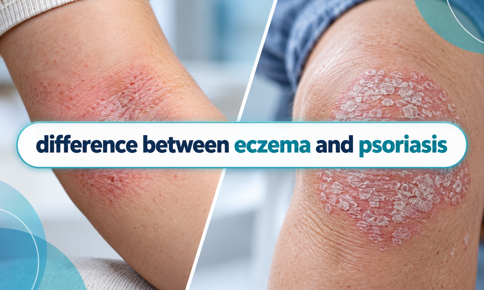 difference between eczema and psoriasis
